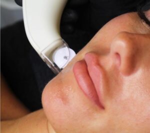 woman getting a crystal clear microdermabrasion treatment